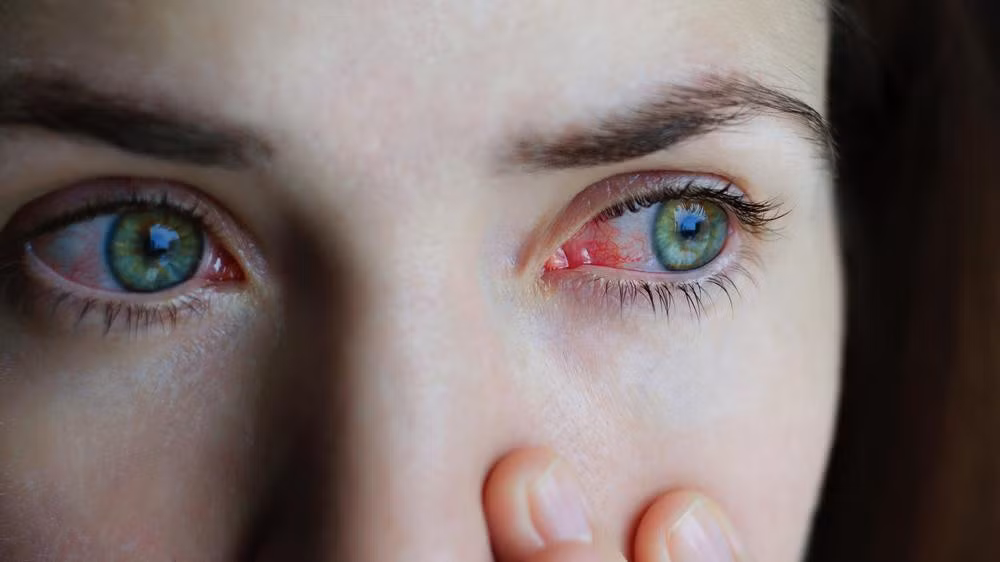 Nguyên nhân phổ biến gây đau mắt đỏ hầu hết bệnh do virus gây ra.