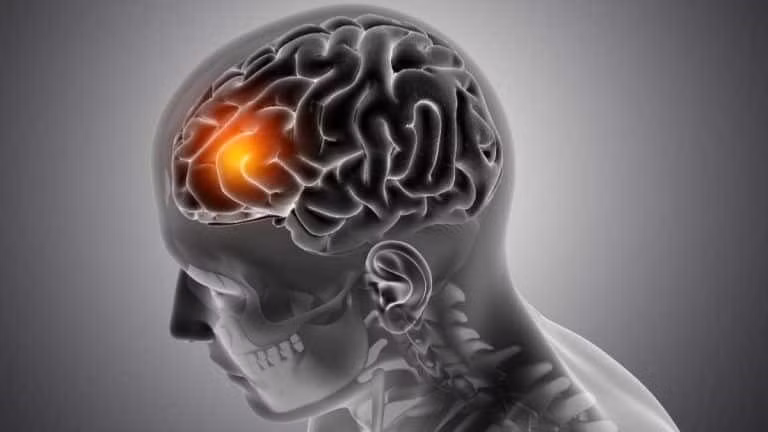 Bệnh nhân Alzheimer có nguy cơ phát triển COVID-19 nghiêm trọng hoặc tử vong cao gấp 3 lần.