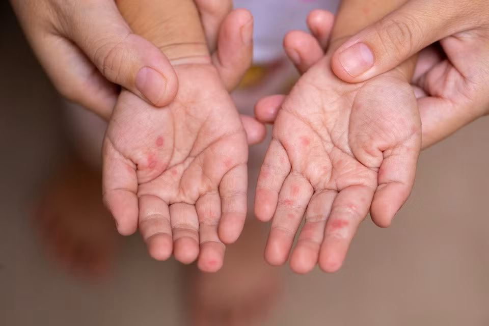 Trẻ phát ban khi mắc virus sởi. Ảnh: Shutterstock.
