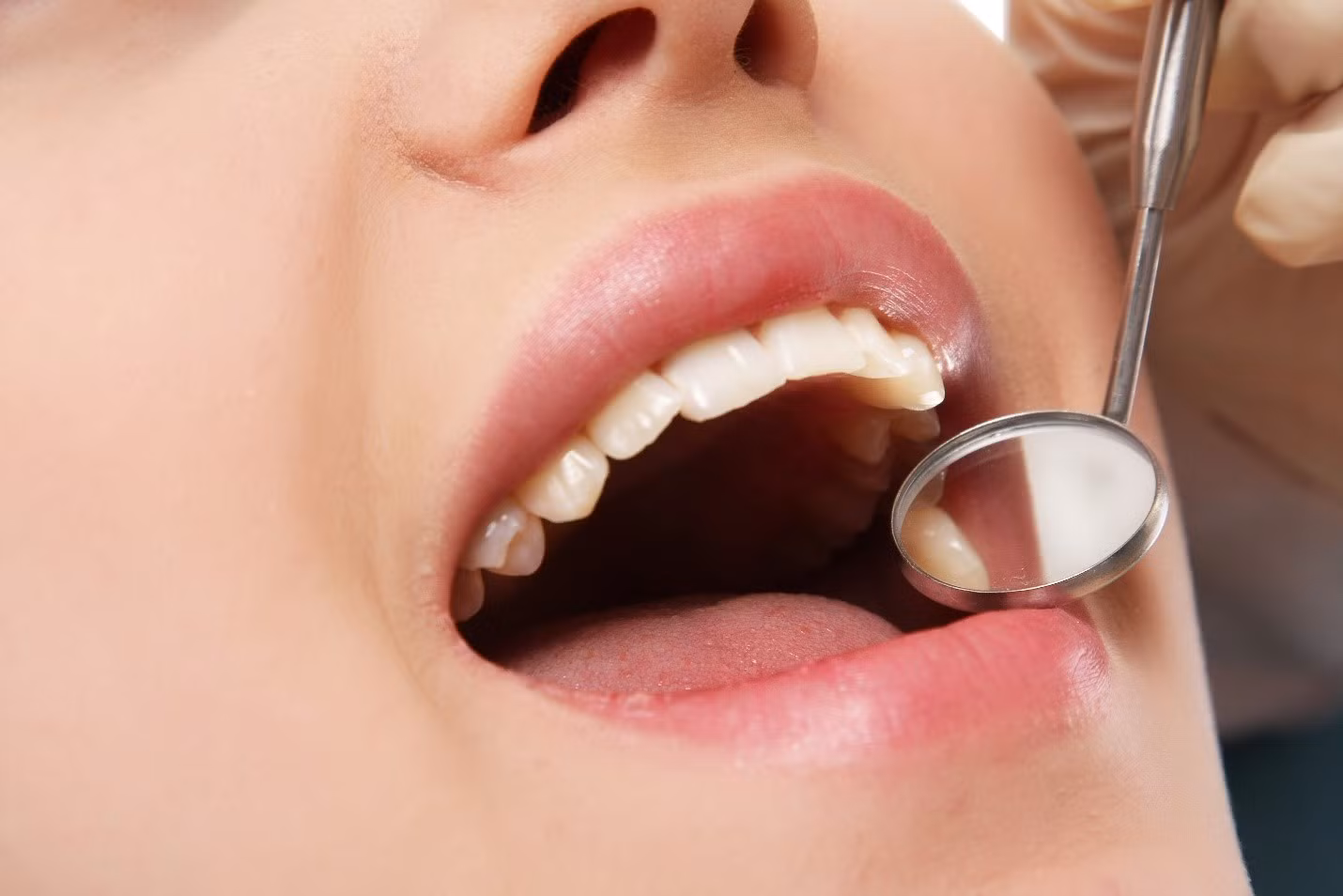 Một trong những nguyên nhân dẫn đến biến chứng sau khi bọc răng sứ là chọn dịch vụ giá rẻ, kém chất lượng.