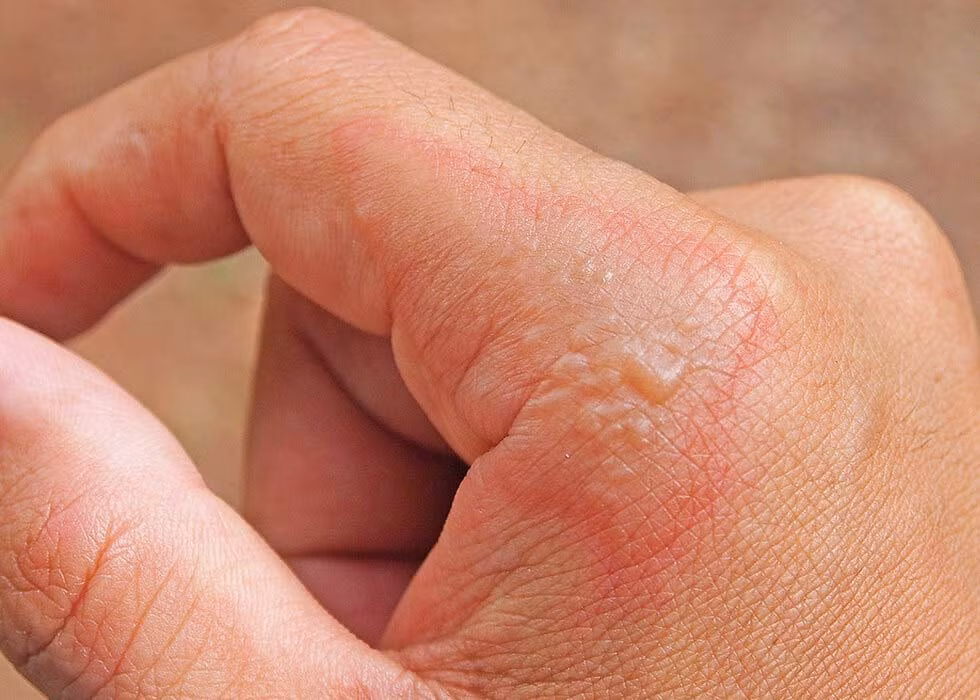 Sau mưa bão, độ ẩm không khí cao cộng với nguồn nước nguy cơ bị ô nhiễm chứa nhiều vi khuẩn gây bệnh sẽ gây các bệnh ngoài da (Ảnh: Internet)