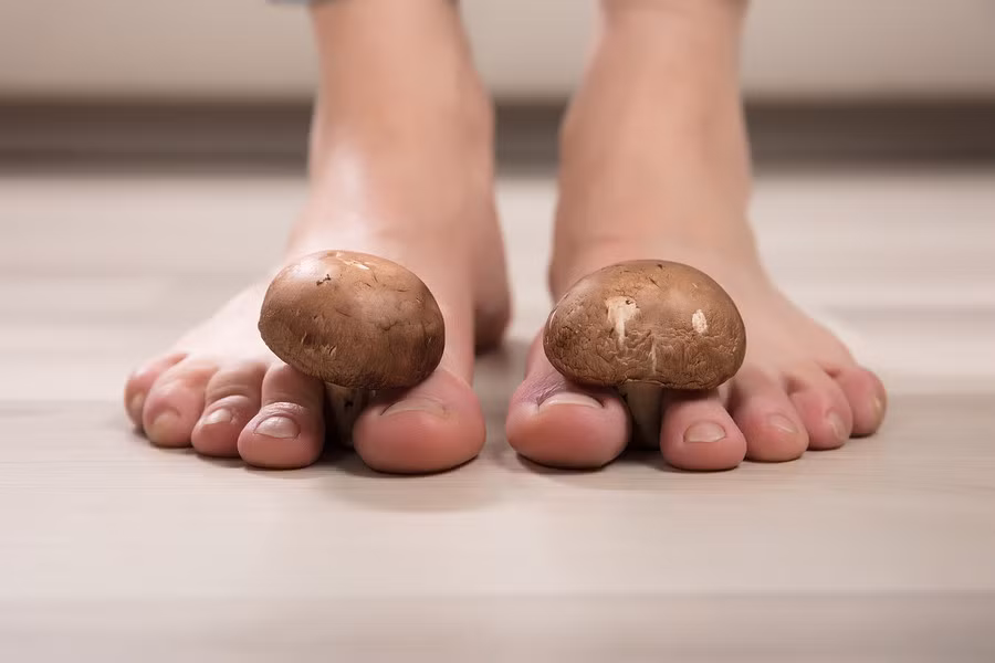 Nước ăn chân nếu không điều trị đúng có thể lây lan tới các bộ phận khác của cơ thể (Ảnh: Internet)