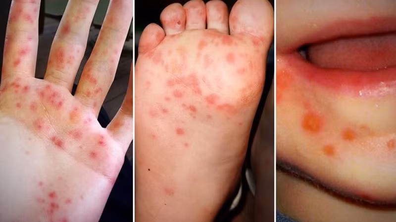 Trẻ mắc tay chân miệng thường xuất hiện các nốt phỏng nước ở bàn tay, bàn chân, miệng.