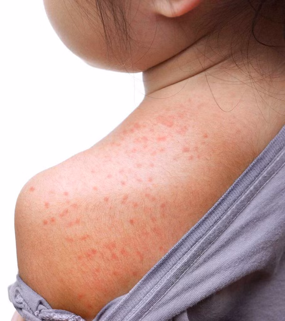 Hình ảnh rôm sảy ở trẻ (Ảnh: NHS)