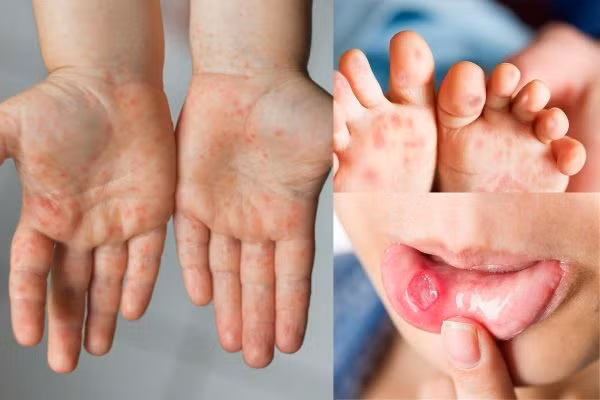 Bệnh tay chân miệng có thể gây biến chứng nguy hiểm nếu không được điều trị kịp thời.