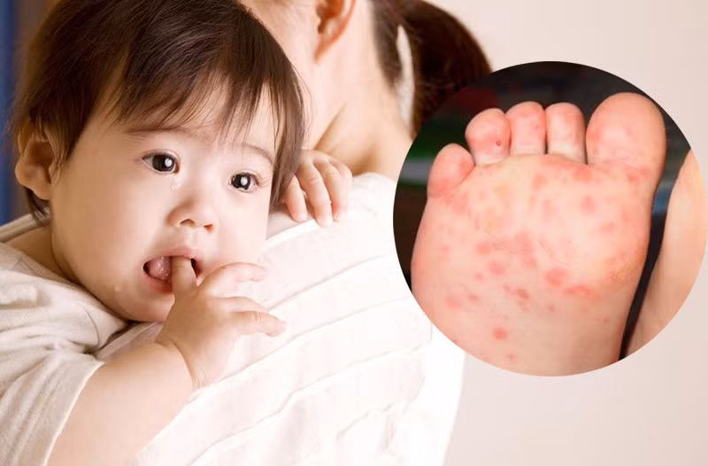 Bệnh tay chân miệng do virus gây ra nên không có thuốc điều trị đặc hiệu. Ảnh minh hoạ.
