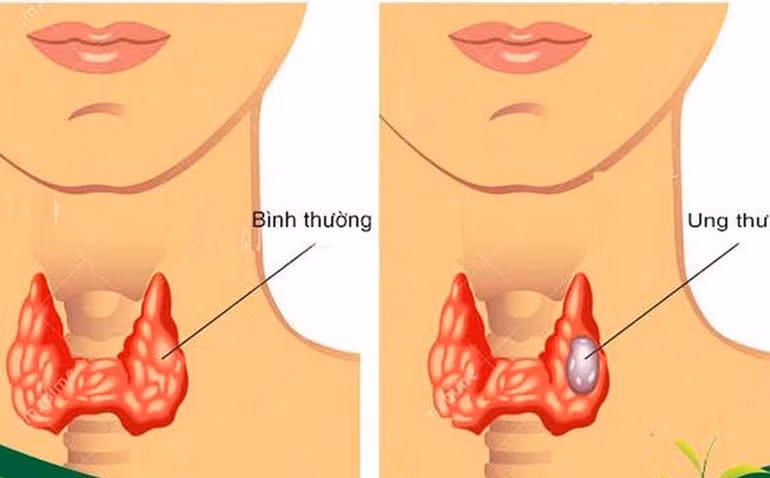 Khối u tuyến giáp lành tính có đau không? ảnh 2
