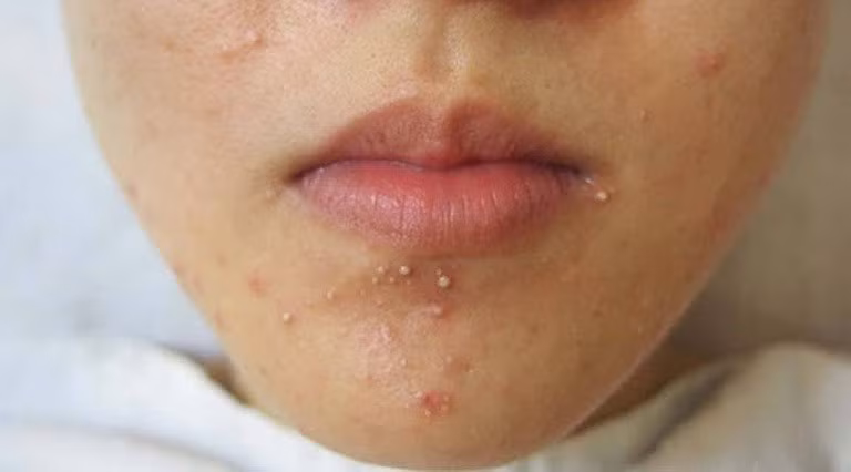 Spa trị mụn nam uy tín hiệu quả, cam kết sạch mụn đến 90% ảnh 1