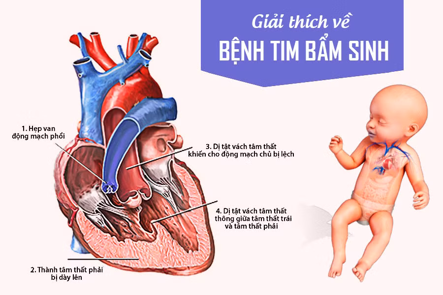 Trẻ mắc dị tật tim bẩm sinh cần lưu ý để tránh nhiễm khuẩn ảnh 2