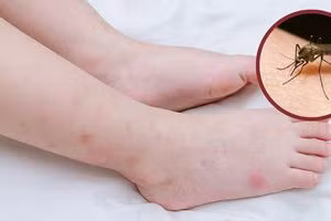 Cách xử lý vết muỗi đốt ảnh 1