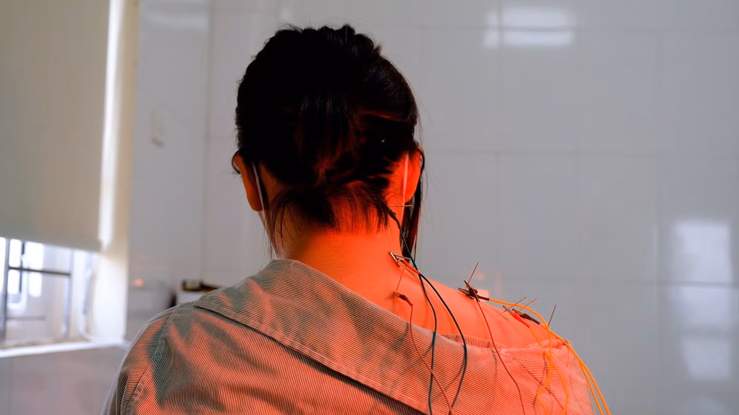 Tùy tình trạng, Bệnh viện Y học cổ truyền Trung ương sẽ kết hợp phương pháp dùng thuốc Đông y với không dùng thuốc như châm cứu, xoa bóp bấm huyệt, giác hơi, cứu ngải,... để điều trị đau cổ vai gáy. Ảnh: Mỹ Ly