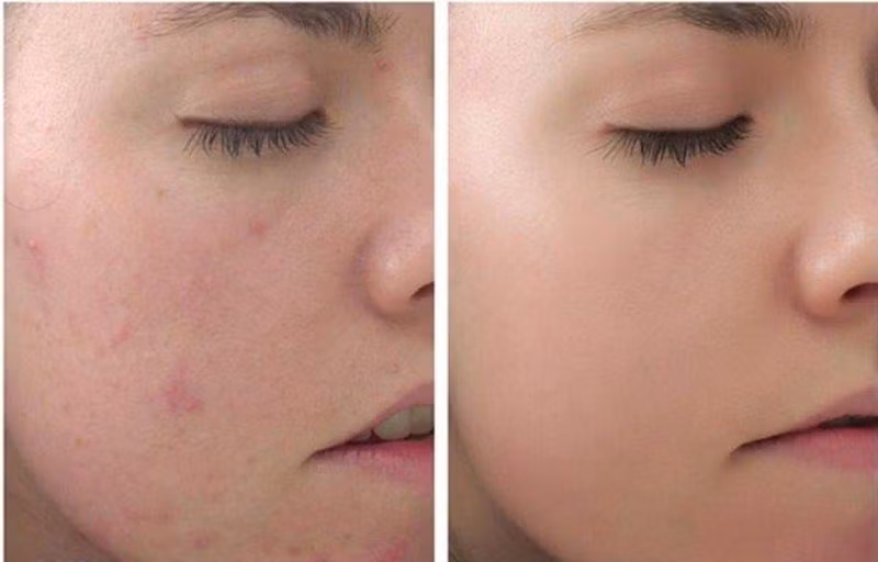 Sau peel da sẽ sáng mịn nhưng cần chăm sóc kỹ để không bị tổn thương do các tác động của môi trường.