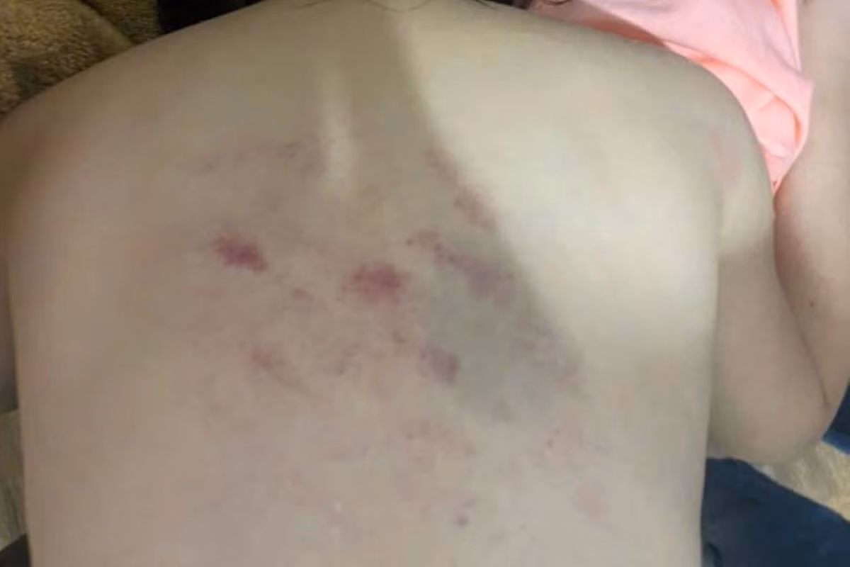 Vết bầm tím trên lưng của bé N. Ảnh: Gia đình cung cấp.