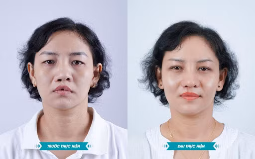 Chị Kim Xuân trước và sau khi chỉnh sửa mũi và sẹo môi dị tật.