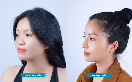 Sự thay đổi rõ rệt của chị Tuyết Trinh sau khi sửa mũi dị tật và xóa sẹo môi.