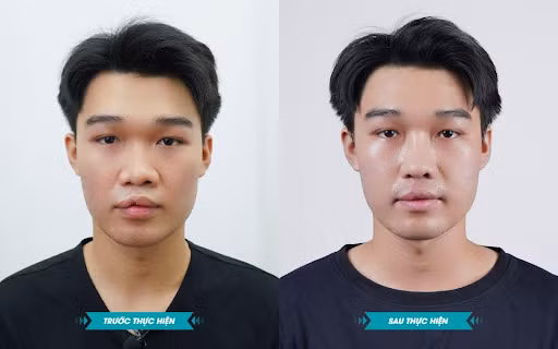 Kết quả đẹp của Thành Đạt thời điểm trước và sau 10 tháng phẫu thuật.
