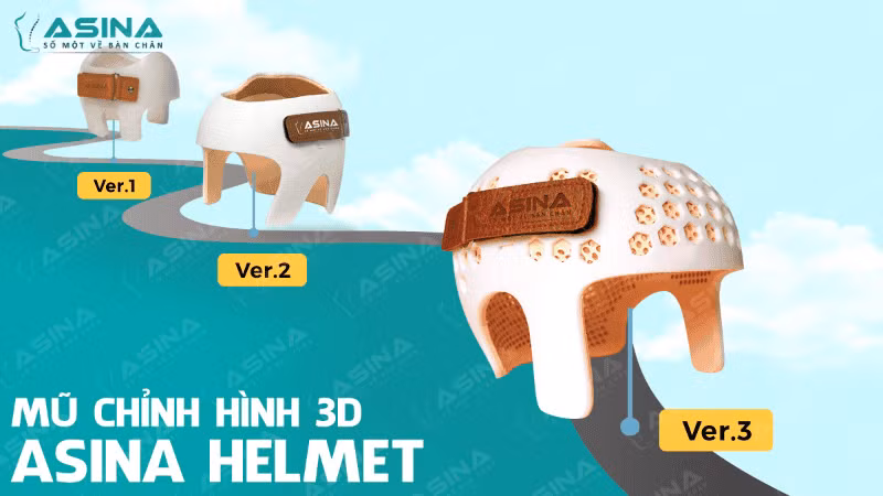 Mũ chỉnh hình 3D ASINA hỗ trợ điều trị đầu bẹt ở trẻ