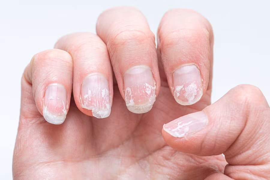 Sọc ngang màu trắng xuất hiện trên móng do thiếu canxi hoặc thiếu axit nicotinic. (Ảnh: ITN)
