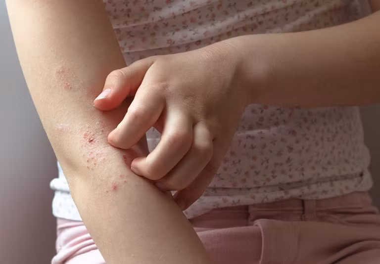 Mùa xuân là thời điểm nhiều người bị ngứa da.