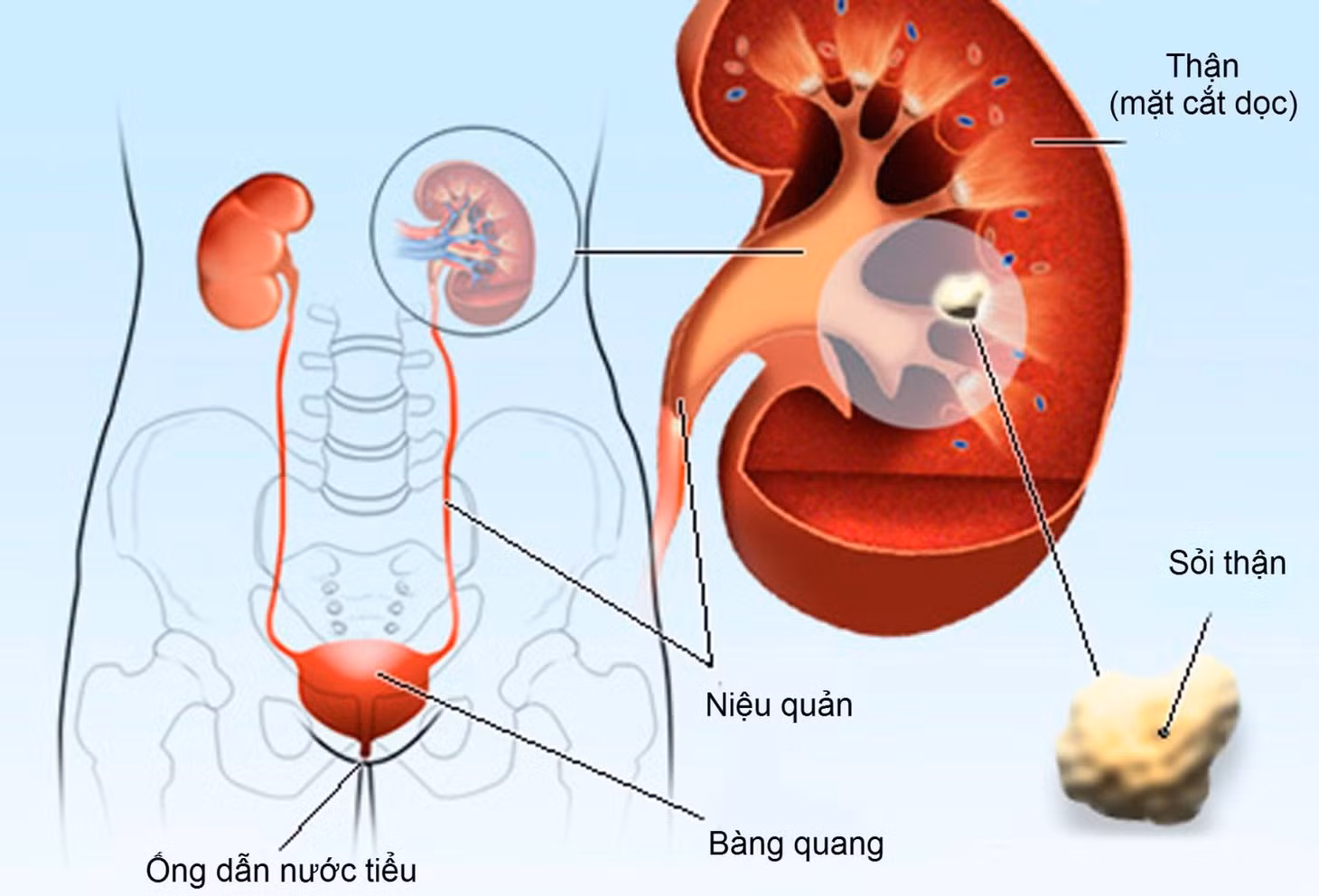 Sỏi thận có thể suy giảm chức năng thận, thậm chí tiến triển thành bệnh thận mạn.