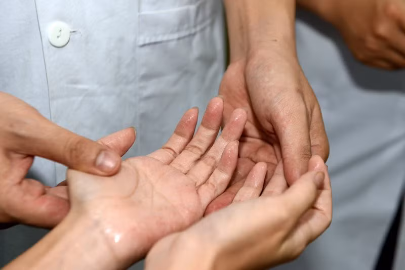 Đổ mồ hôi tay quá mức, còn được gọi là tăng tiết mồ hôi lòng bàn tay.