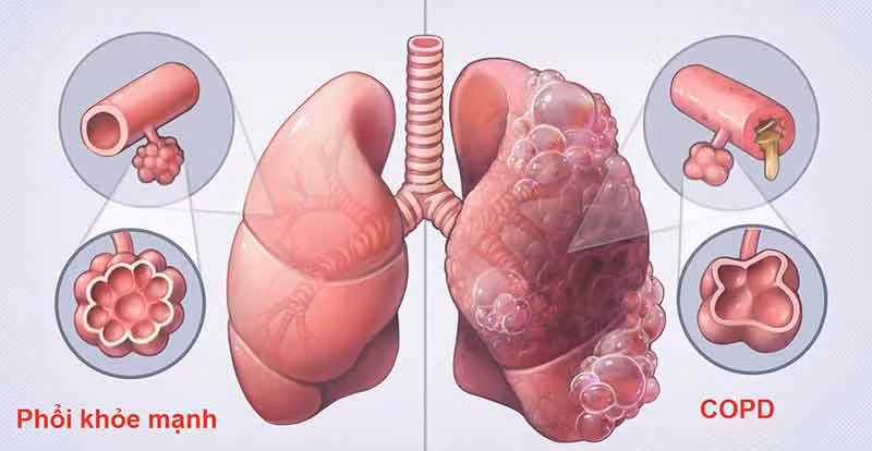Bệnh phổi tắc nghẽn mạn tính. (Ảnh minh họa)