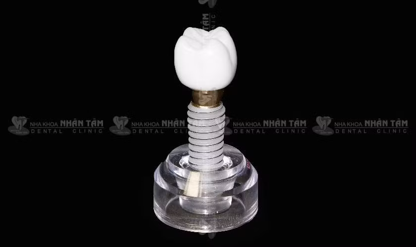 Trồng răng Implant khôi phục hoàn hảo cả chân và thân răng