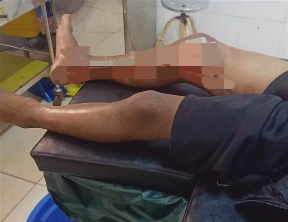 Chân cháu bé Y.N bị tẩm xăng đốt. Ảnh: T.X