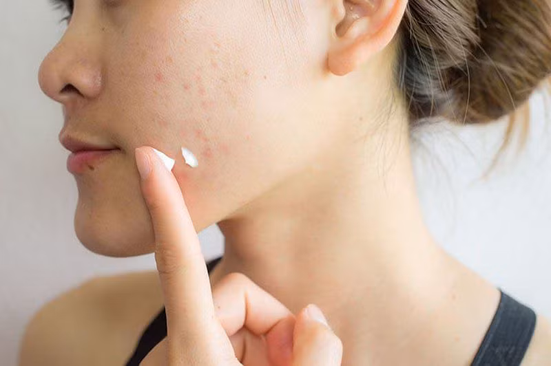 Đến khám da liễu để được bác sĩ lên liệu trình điều trị phù hợp