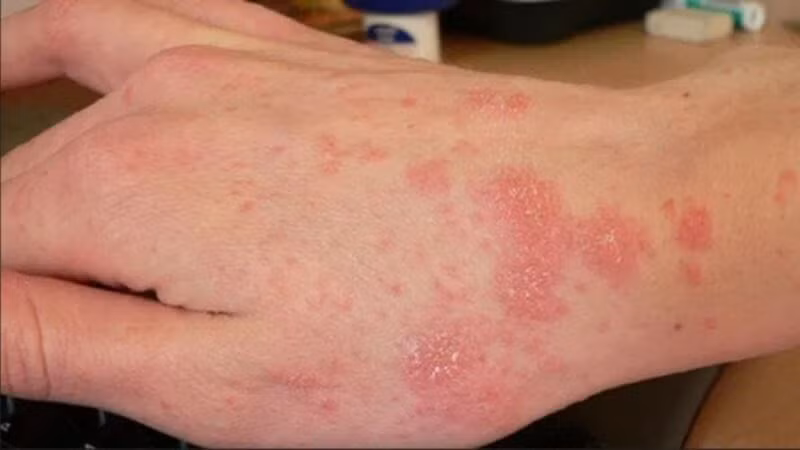Viêm da cơ địa đặc trưng bở những mảng da ban đỏ, rất ngứa...