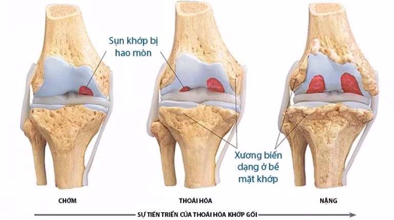 Tuổi tác là nguyên nhân chính gây ra tình trạng thoái hóa khớp gối.