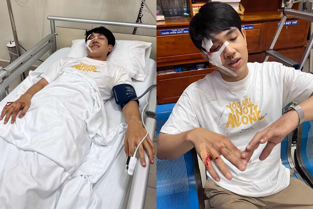 Long Hoàng bị tai nạn ảnh hưởng nghiêm trọng vùng mặt (Ảnh: Nhân vật cung cấp).