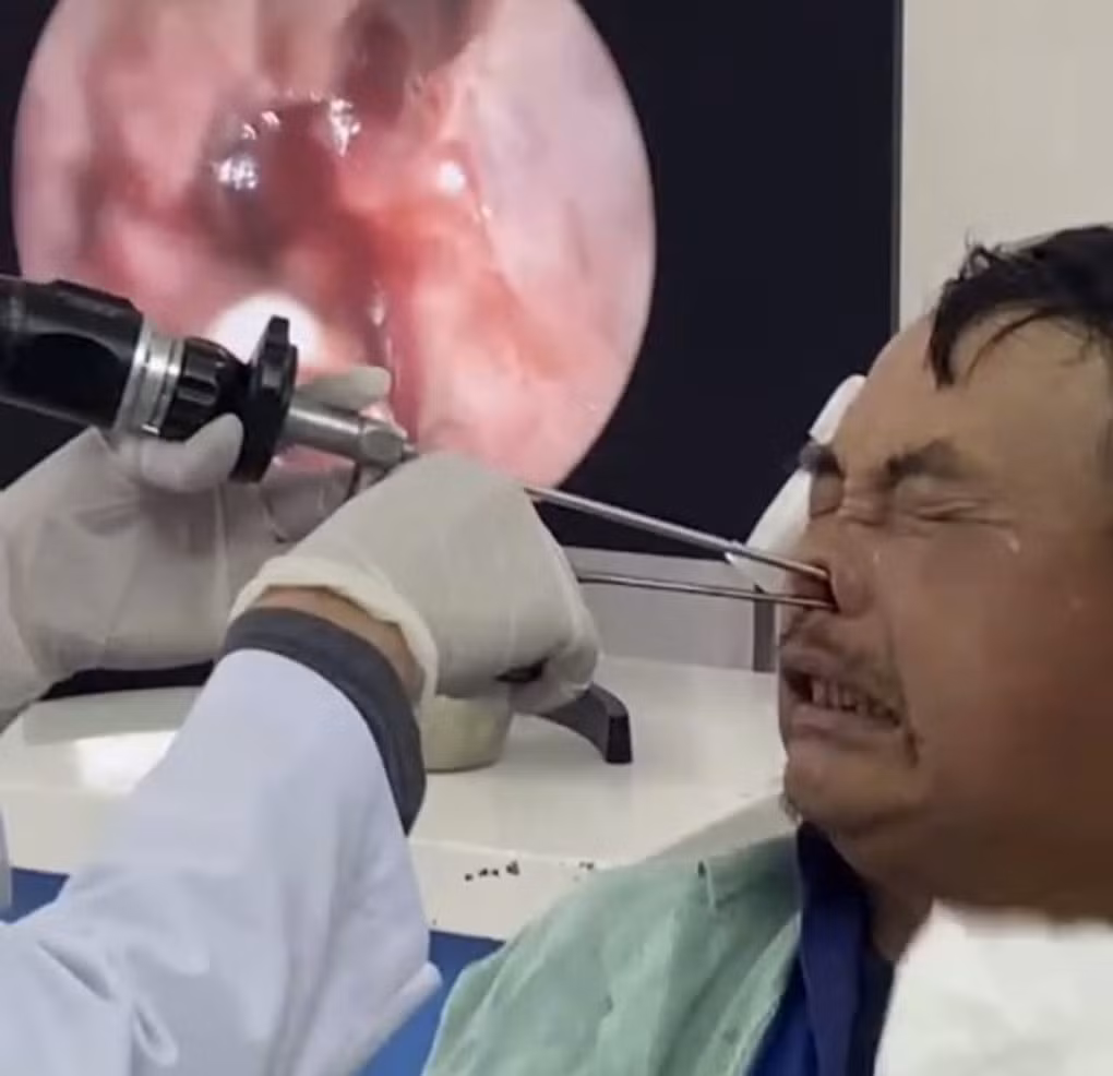 Sau khi nội soi bác sĩ Bệnh viện đa khoa tỉnh Lào Cai phát hiện ra hàng trăm con giòi làm tổ trong mũi của bệnh nhân (Ảnh: Sở Y tế Lào Cai).
