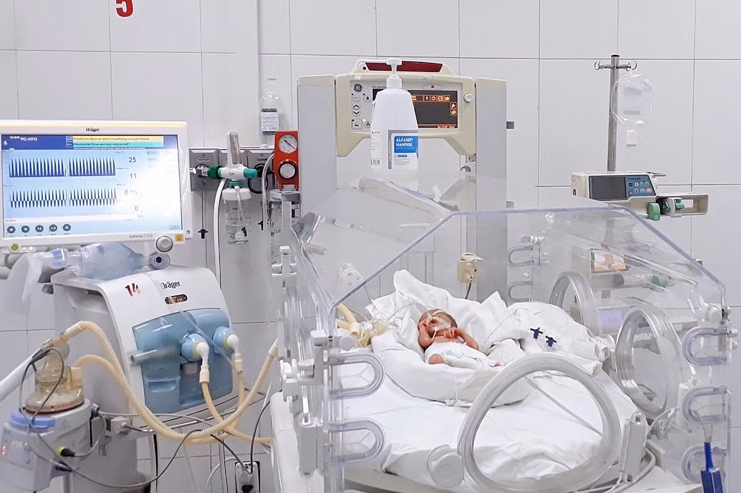 Bé An Bình được thở máy tần số cao HFO tại khu cách ly của Bệnh viện Sản Nhi Bắc Giang. 'Chiến binh nhí' cuối cùng ra viện tại khu cách ly BV Sản Nhi Bắc Giang