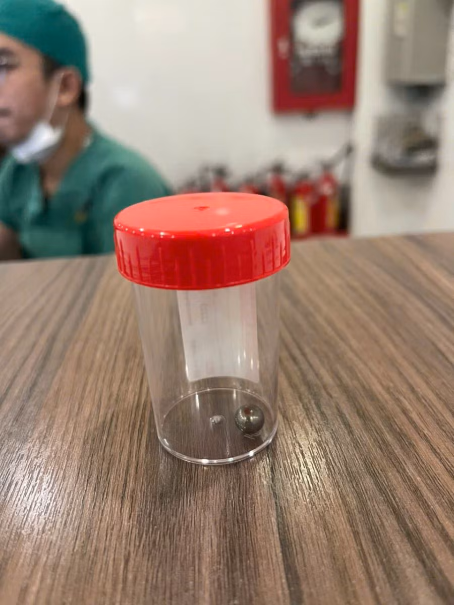 Viên bi sắt từ súng đồ chơi xuyên thủng vùng má trái của bé trai, đã được các bác sĩ nội soi lấy ra. Ảnh: B.S