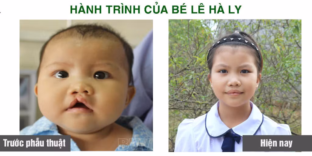 Bé Lê Hà Ly (huyện Ba Chẽ) trước và sau khi phẫu thuật.