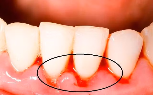 Chảy máu chân răng do tình trạng viêm nướu hoặc do thiếu hụt Vitamin C gây ra.