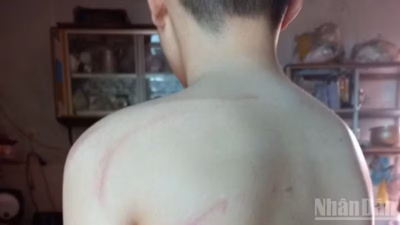Em L.N.H.B bị nhiều thương tích nghi do thầy Nguyễn An Phong đánh.