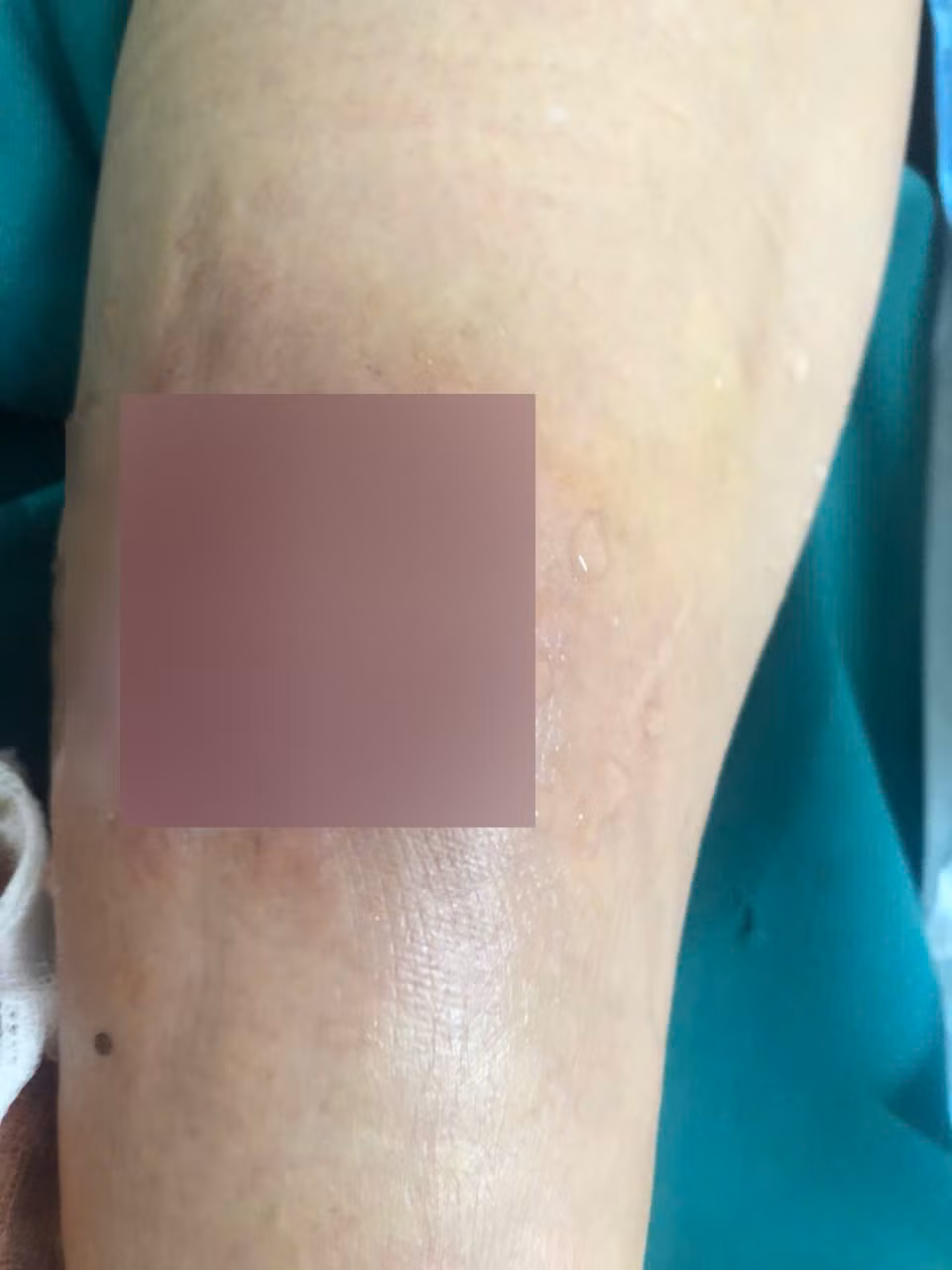 Chân chị Đ.T.L.A bị hoại tử sau khi bị đánh. Ảnh: Ngọc Anh