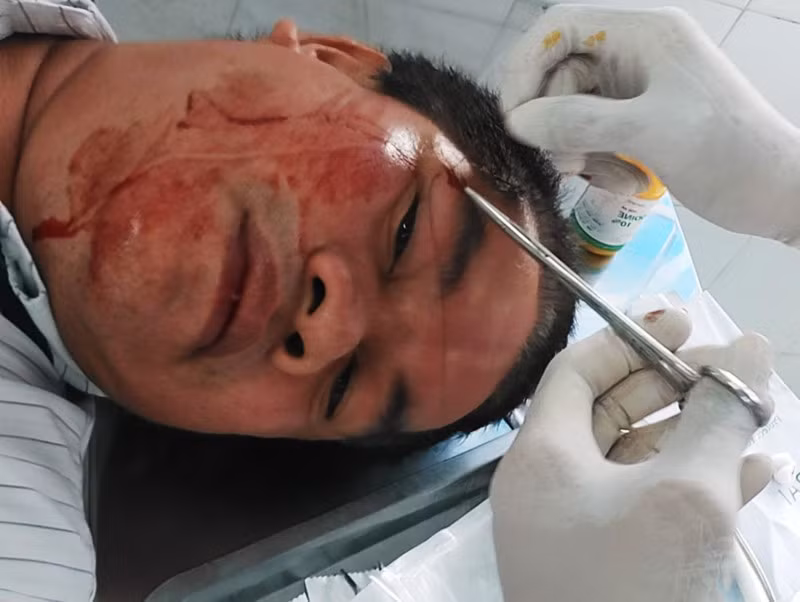 Anh Tài được khâu vết thương tại Trạm Y tế xã Long Sơn.
