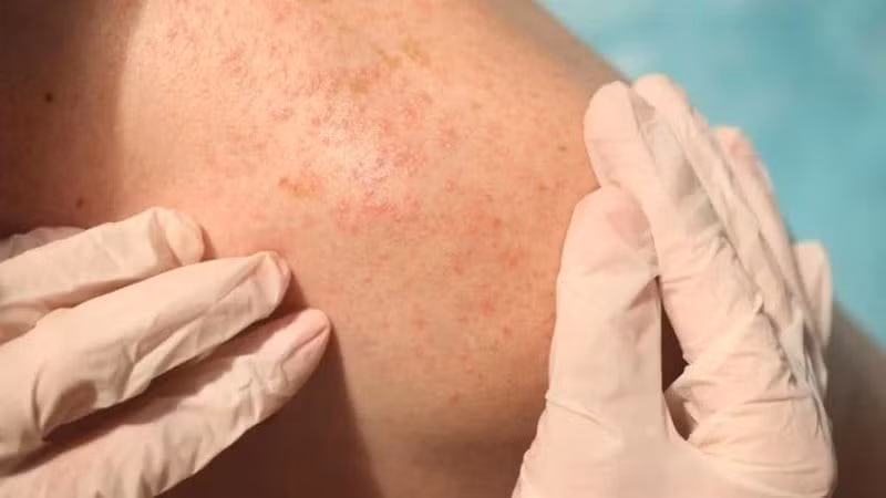 Mùa hè thời tiết nắng nóng khiến nhiều người bị mụn nhọt.