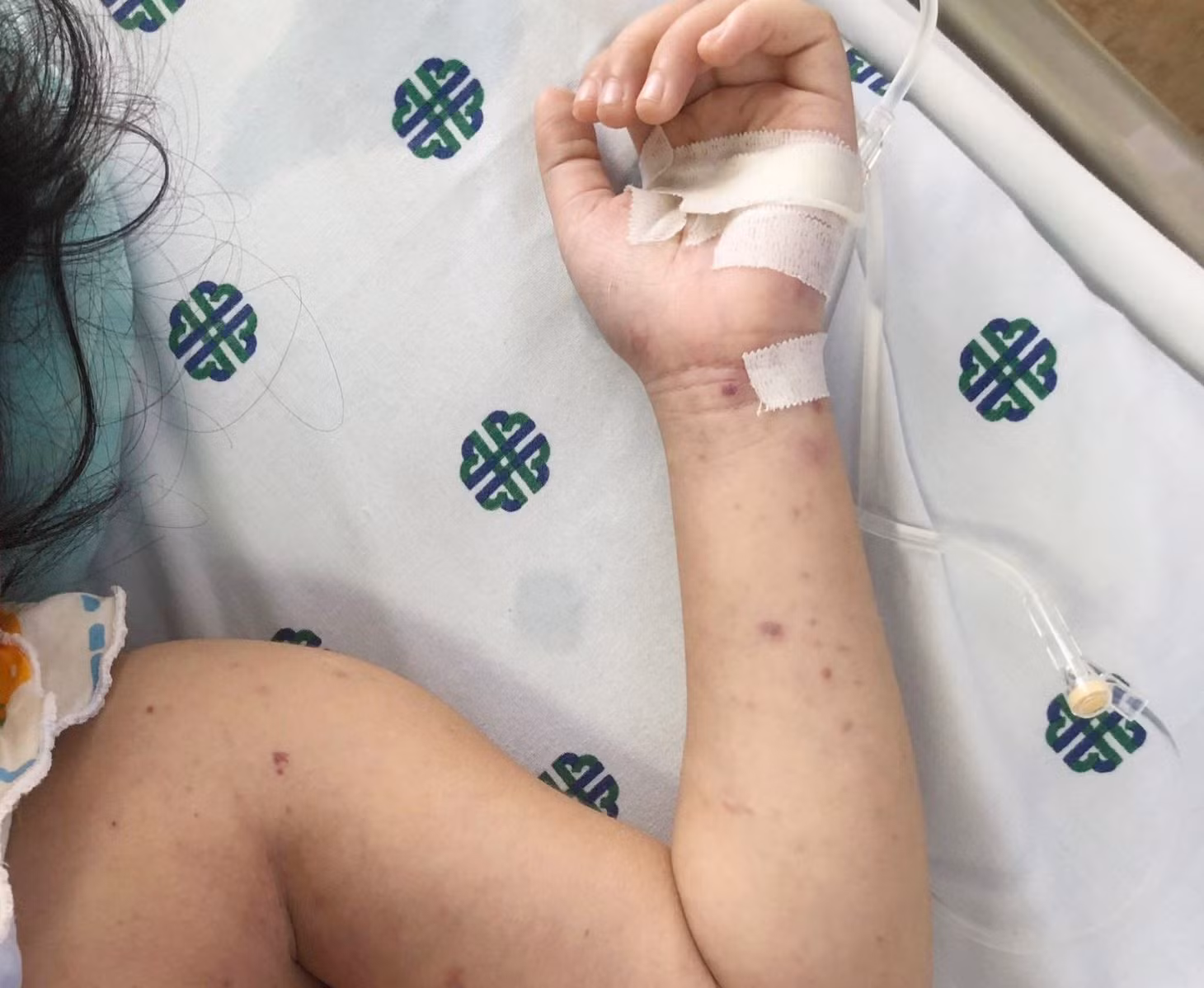 Tình trạng da bị nổi nốt xung huyết của bé gái 5 tuổi bị viêm não mô cầu. Ảnh: CDC Tây Ninh.