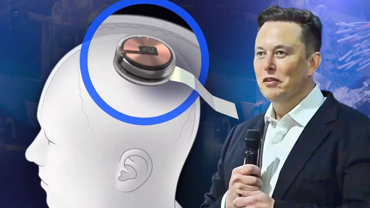 Elon Musk đã ví quy trình phẫu thuật cấy chip não giống như việc "thay thế một mảnh hộp sọ bằng một chiếc đồng hồ thông minh".
