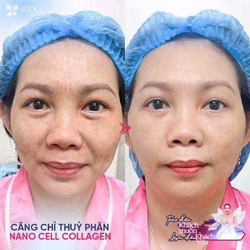 Làn da của khách hàng được trẻ hóa, xóa vết thâm mụn, xóa nhăn hoàn toàn.