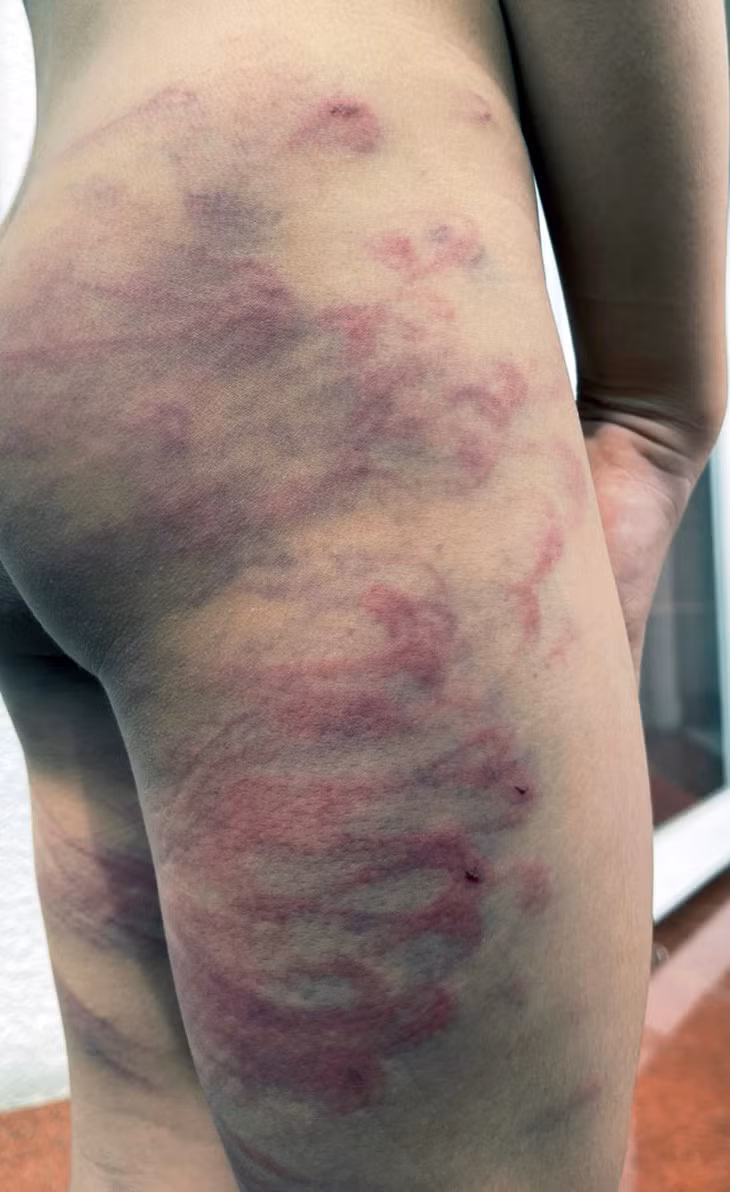 Vết thương ở mông và đùi bé trai sưng tấy, tím tái và có chỗ rách da, ứa máu - Ảnh: A.B.