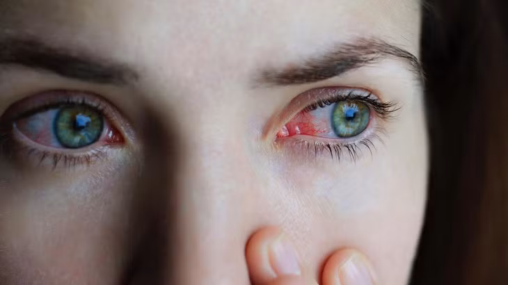 Nguyên nhân phổ biến gây đau mắt đỏ hầu hết bệnh do virus gây ra.