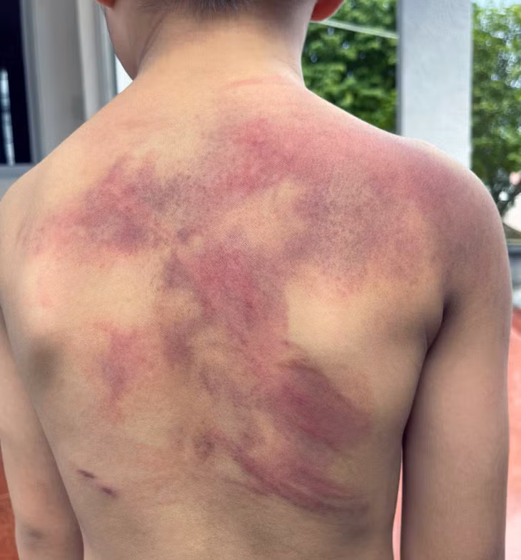 Lưng bé trai chi chít vết lằn đỏ, sưng, bầm tím do cha ruột đánh - Ảnh: A.B.