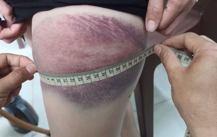Vết bầm trên người chị T.