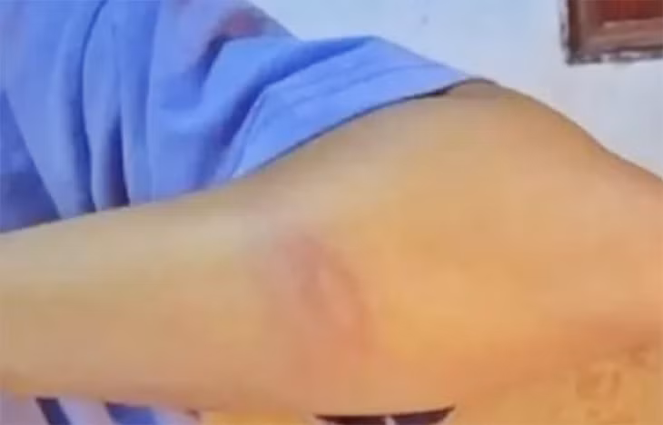 Vết bầm tím trên tay nữ sinh