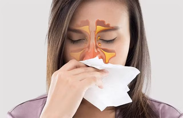 Với những người có cơ địa dị ứng viêm mũi, viêm xoang thường lo lắng khi mùa mưa lại đến.